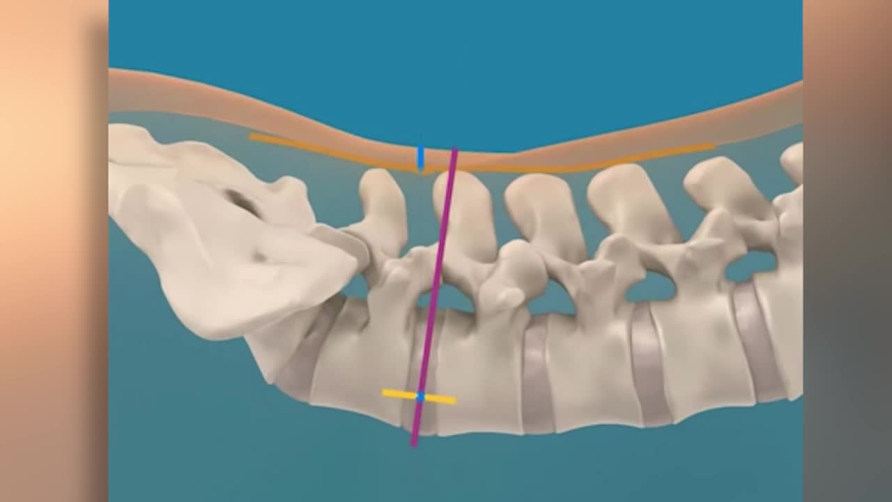 Featured image for "OLLIF Procedure Set to Revolutionize Spine Surgery"