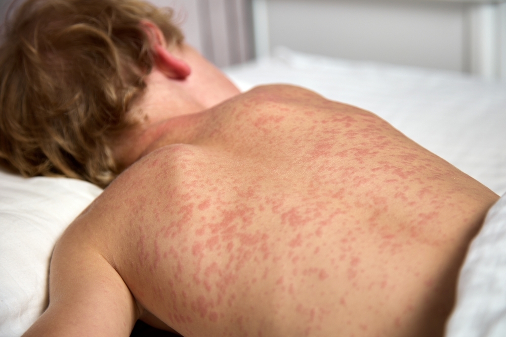 Wyoming Reports First Measles Case in 15 Years in Casper