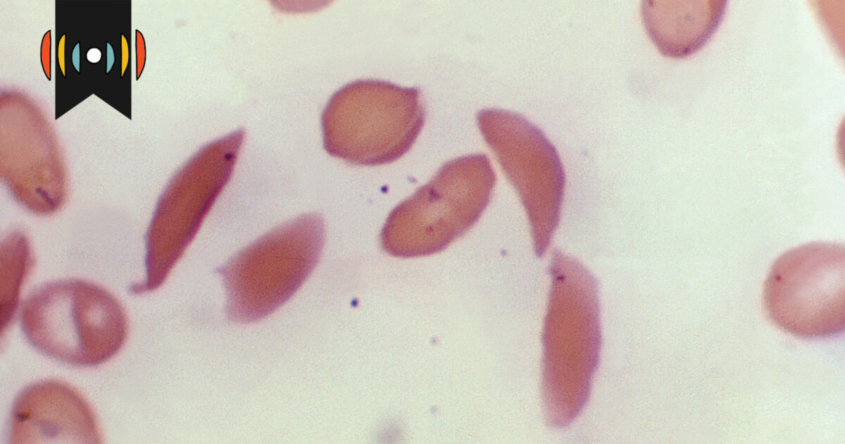 Featured image for "Revolutionary CRISPR Gene-Editing Breakthrough Offers New Hope for Sickle Cell Treatment"