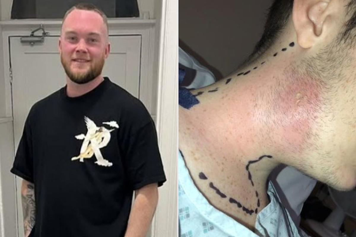 Featured image for Man Hospitalized After Pimple Popping Leads to Severe Abscess