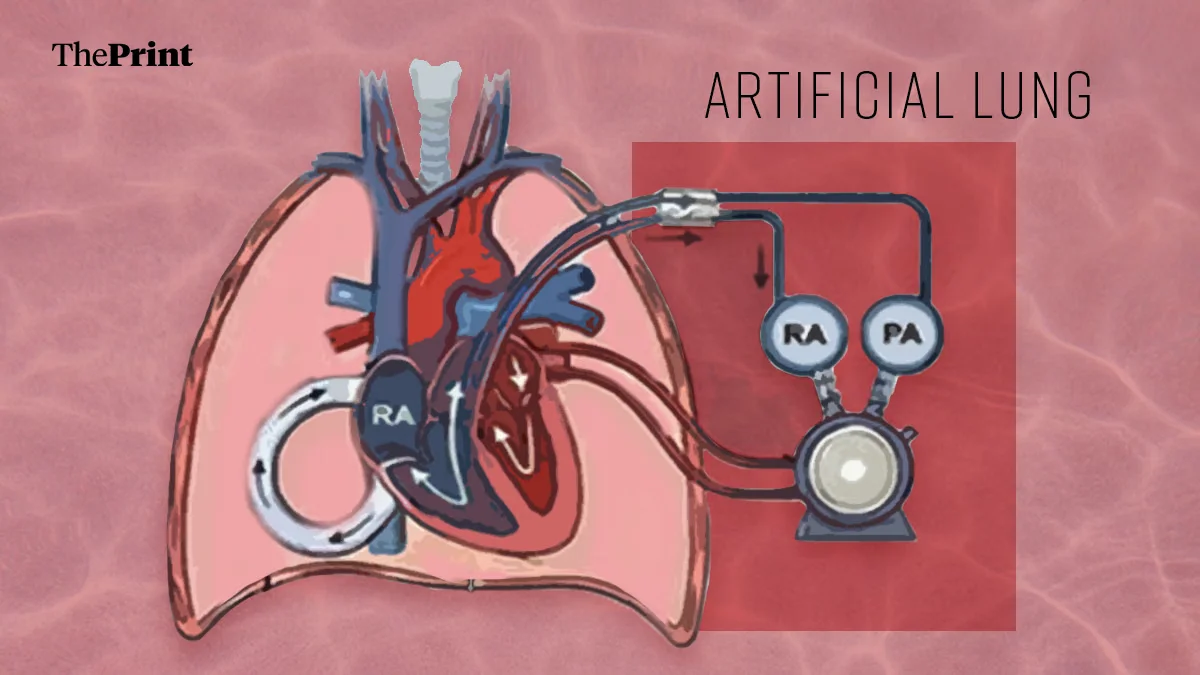 Two Days Without Lungs: A Case That Could Redefine Transplant Medicine