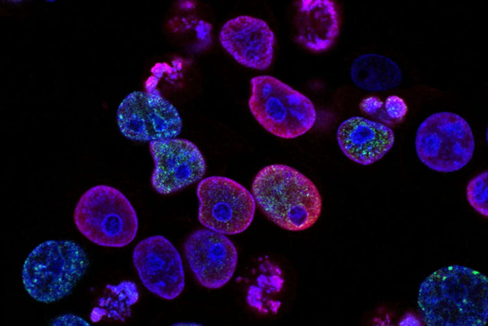 Engineered donor T-cells become a living drug to beat untreatable leukemia
