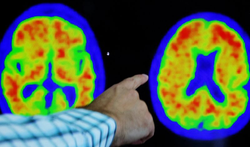 Revolutionary Alzheimer's Diagnosis: Embracing a Cancer-like Rating Scale