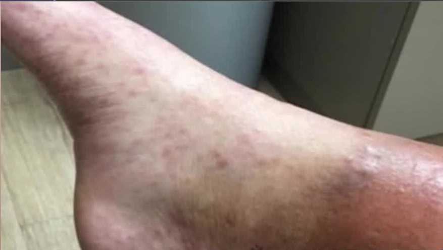 Leprosy Cases on the Rise in Florida: CDC Alert