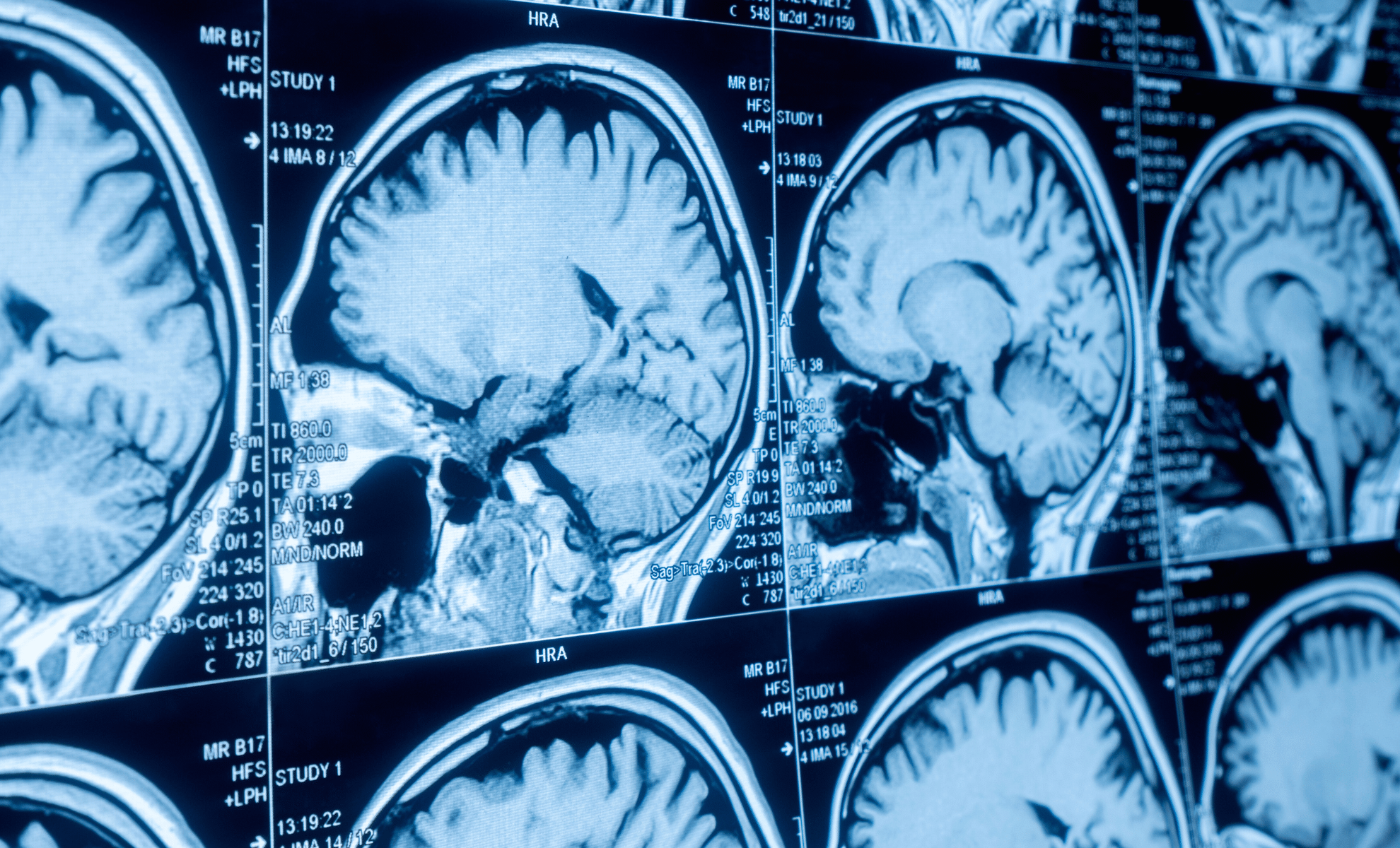 Featured image for Innovative Brain Stimulation Offers New Hope for Depression Treatment