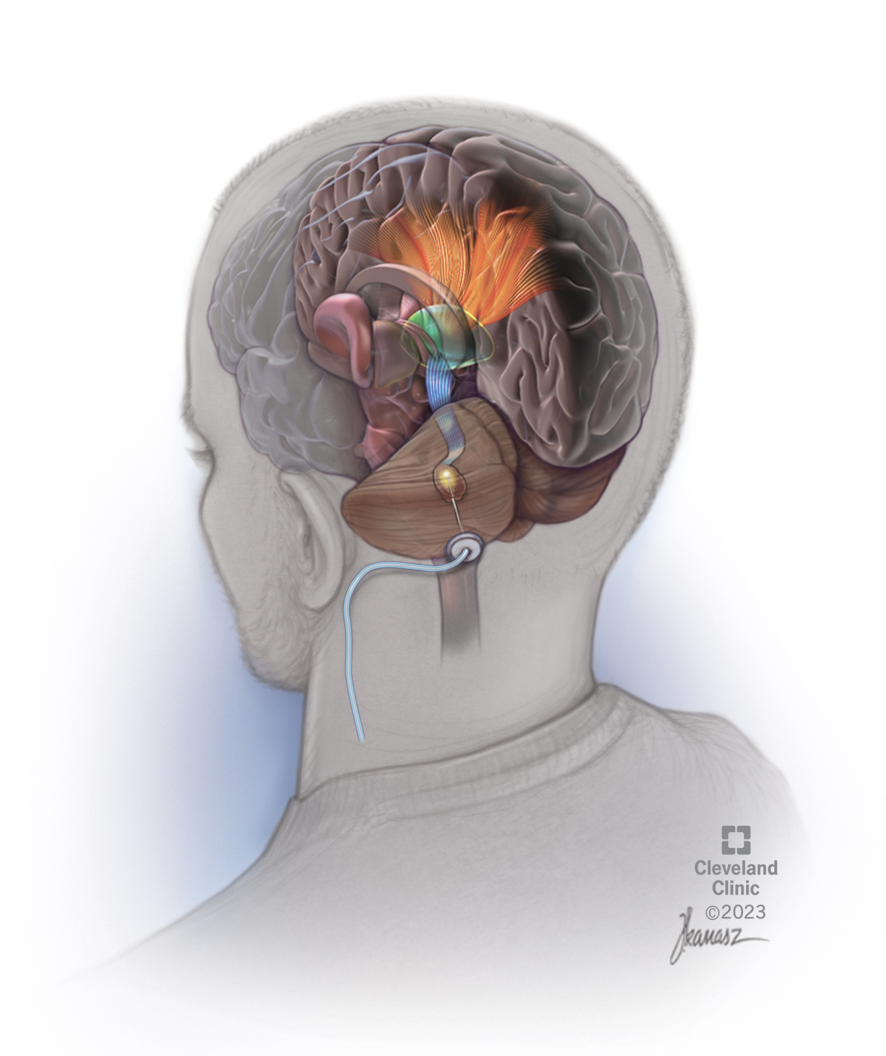 Featured image for Promising Results: Deep Brain Stimulation Offers Hope for Stroke Rehabilitation
