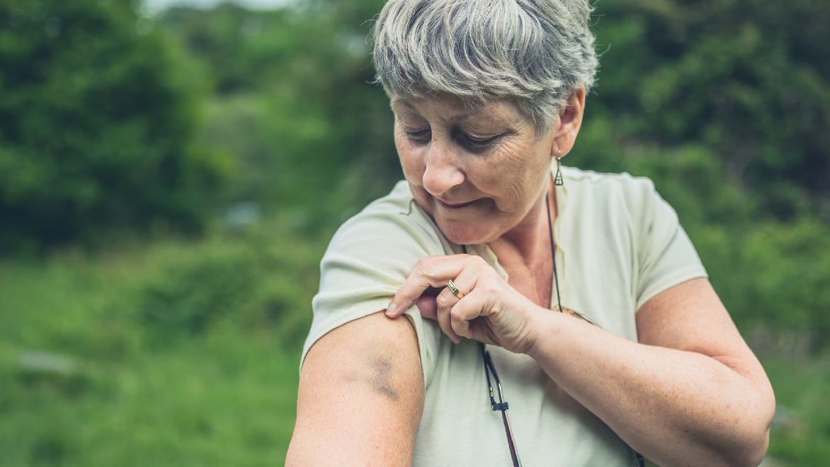 Featured image for "Quick Tips to Heal Bruises Fast"