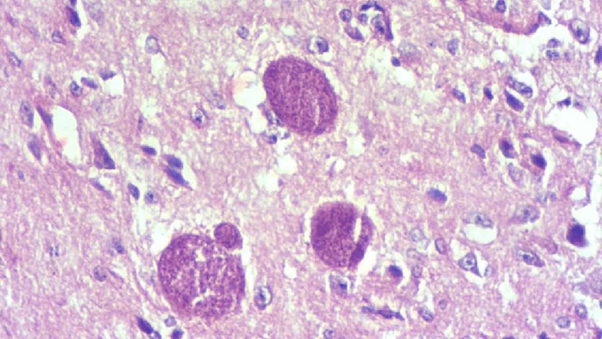 Featured image for "Long-Term Effects of Parasite in Contaminated Meat on Memory and Learning Revealed by Study"