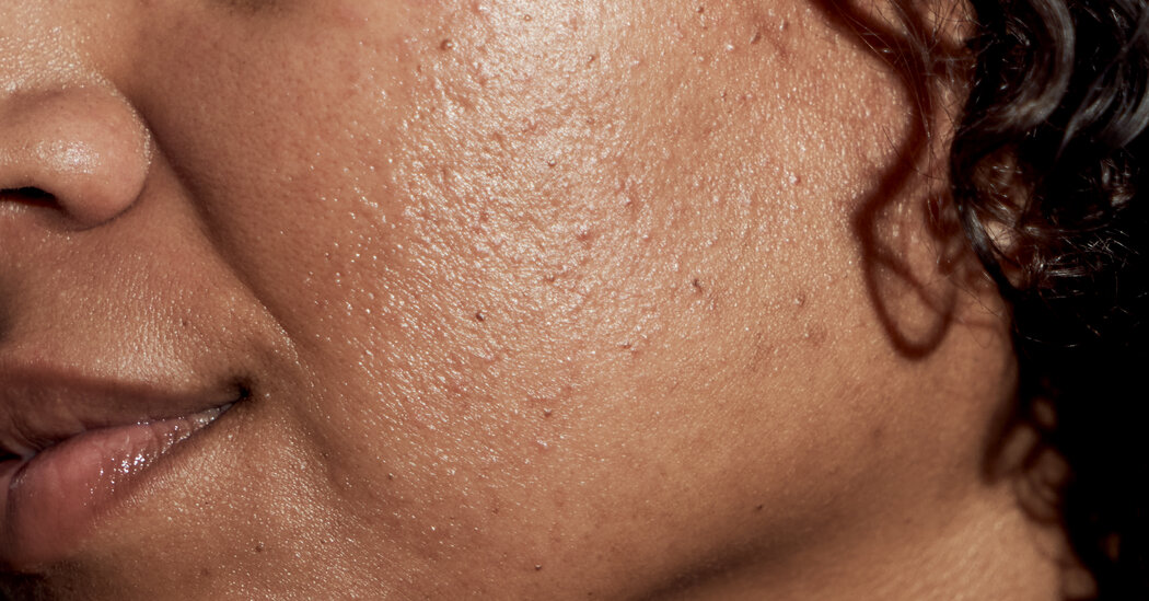 Featured image for Understanding and Treating Adult Acne: Causes and Solutions