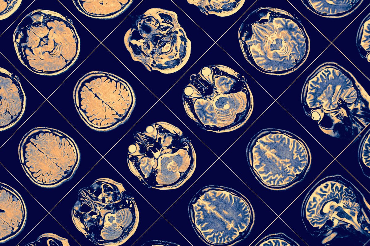 Major Study Identifies New Genes Linked to Schizophrenia Risk