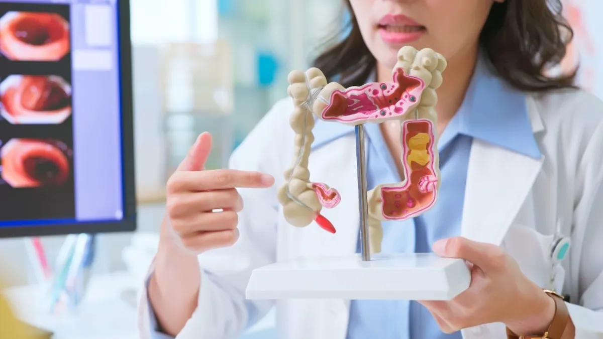 Featured image for What to Do After Discovering Colon Polyps