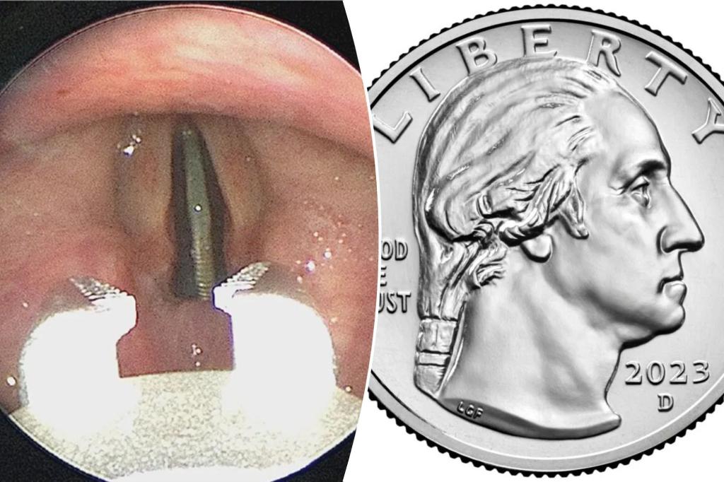 Featured image for Teen's Vocal Cord Mishap: Coin Lodged in Throat Shocks Doctors