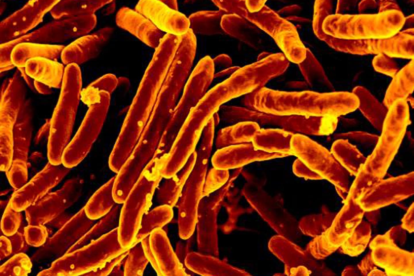Tainted bone grafts cause second deadly TB outbreak