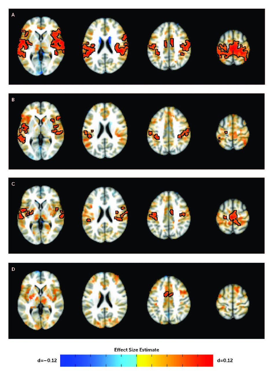 "Brain Connections Linked to Youth ADHD Identified by NIH Researchers"