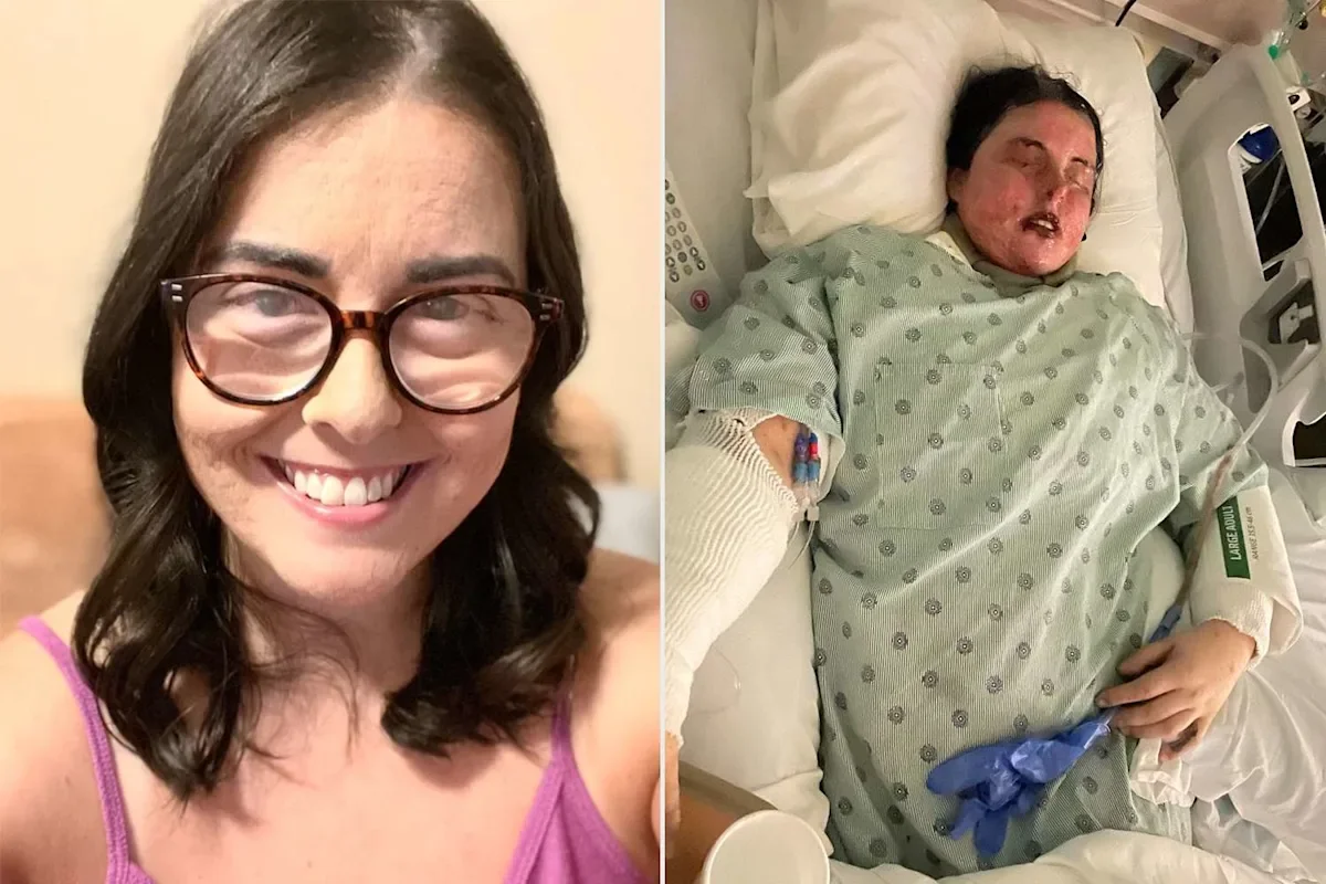 Illinois Mom Survives Rare Skin Disease, Loses 87% of Skin and Her Sight