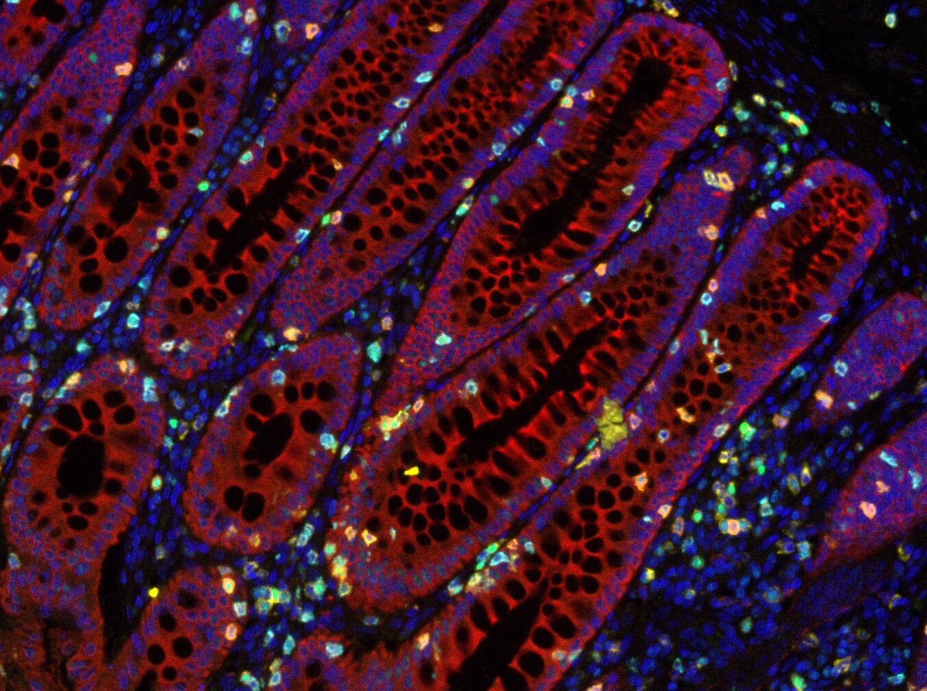 Revolutionary Drug Eradicates Bowel Cancer, Offering Hope to Patients