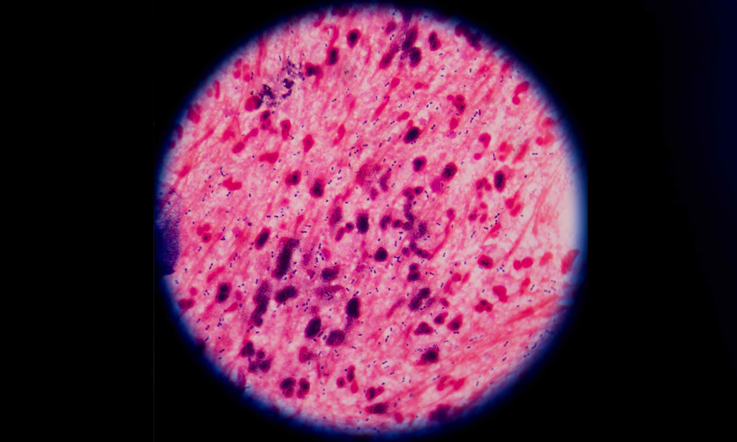 Typhoid Fever Develops Antibiotic Resistance, Sparks Alarm