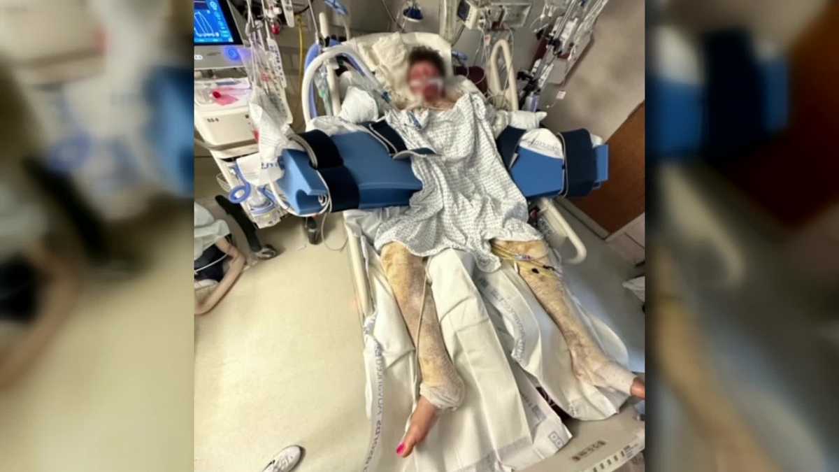 Featured image for TikTok Challenge Results in Teen with 80% Body Burns