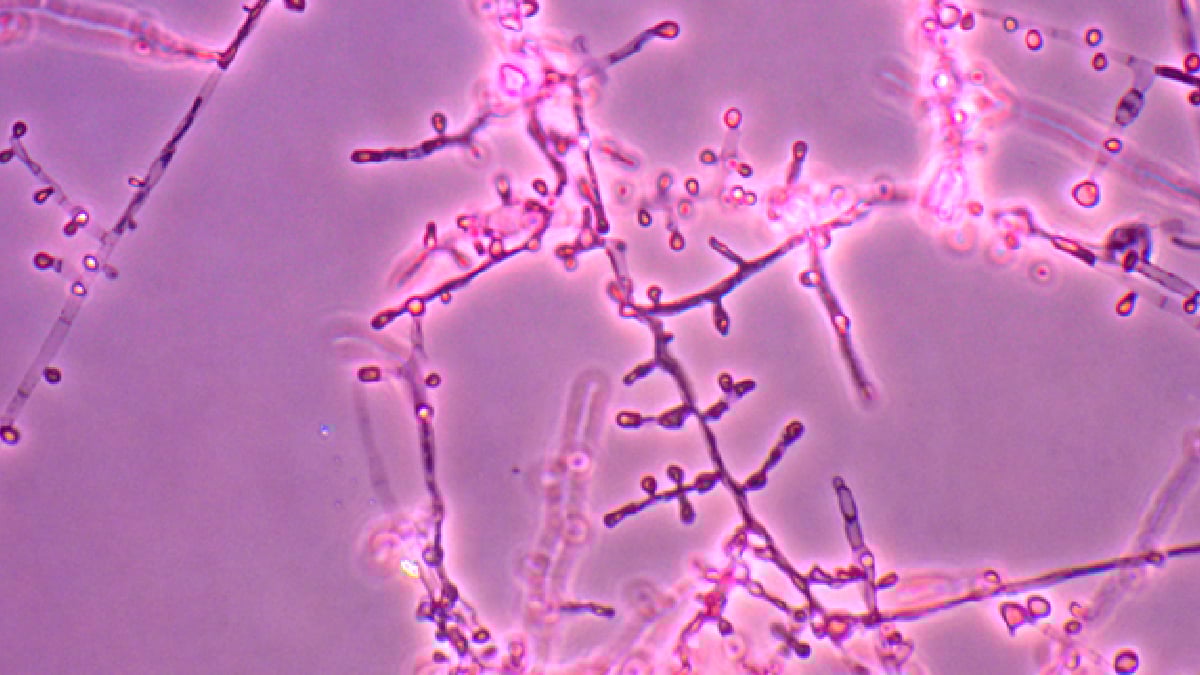 Featured image for Drug-resistant ringworm cases discovered in NYC, first in the US.