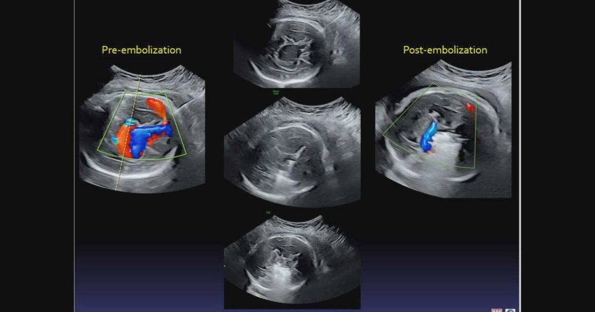 Featured image for Revolutionary in-utero brain surgery performed by Boston doctors.