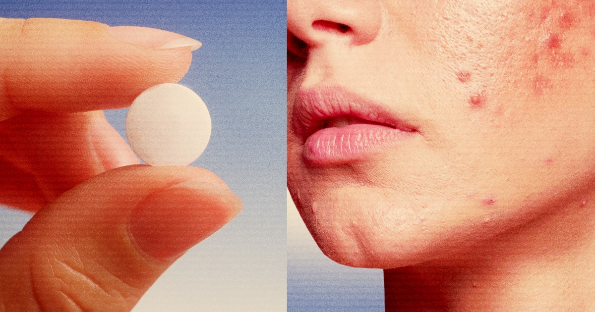 Featured image for "Blood Pressure Drug Emerges as Top Acne Treatment for Women"