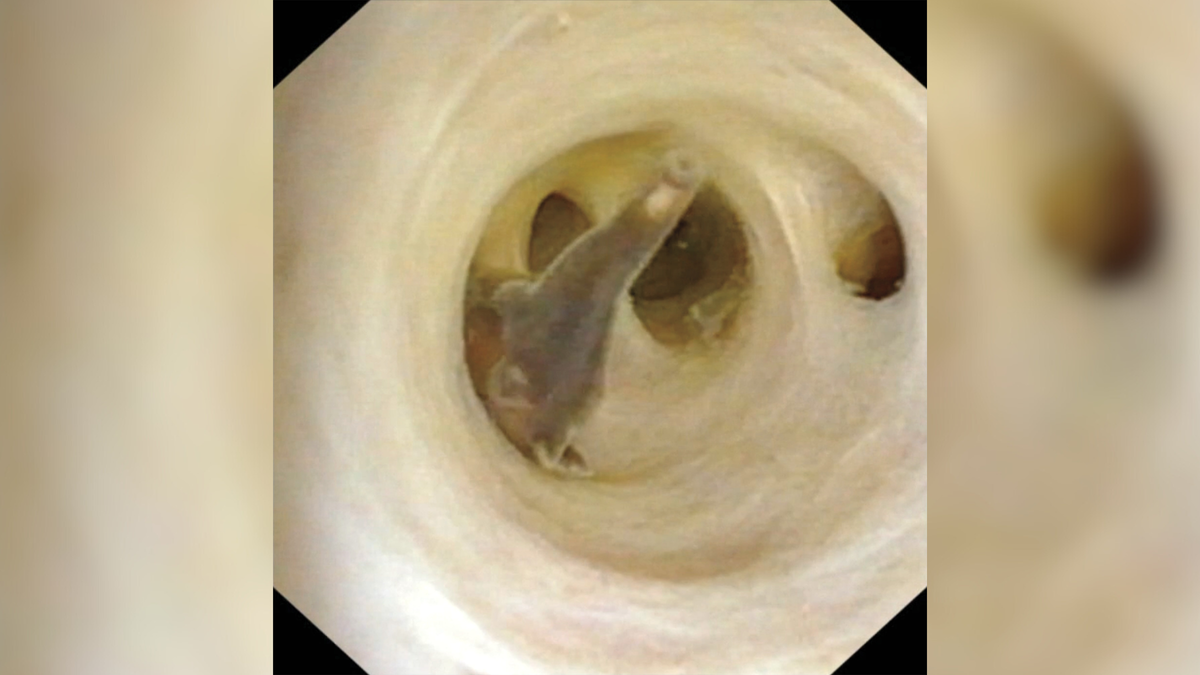 "Surgeons Extract Live Parasitic Worms from Elderly Man's Abdomen in Shocking Procedure"