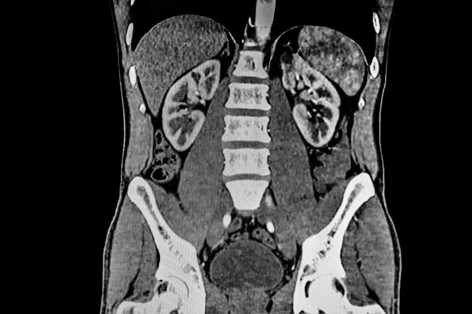 Featured image for Decoding the Insights of Abdominal CT Scans