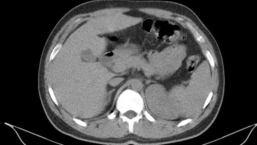 Featured image for Florida Man Develops Flesh-Eating Infection After Being Bitten by Relative During Family Brawl