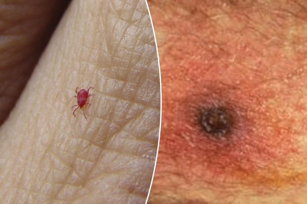 Featured image for "Emerging Threat: Deadly Typhus Spreads to US via Bug Bites"