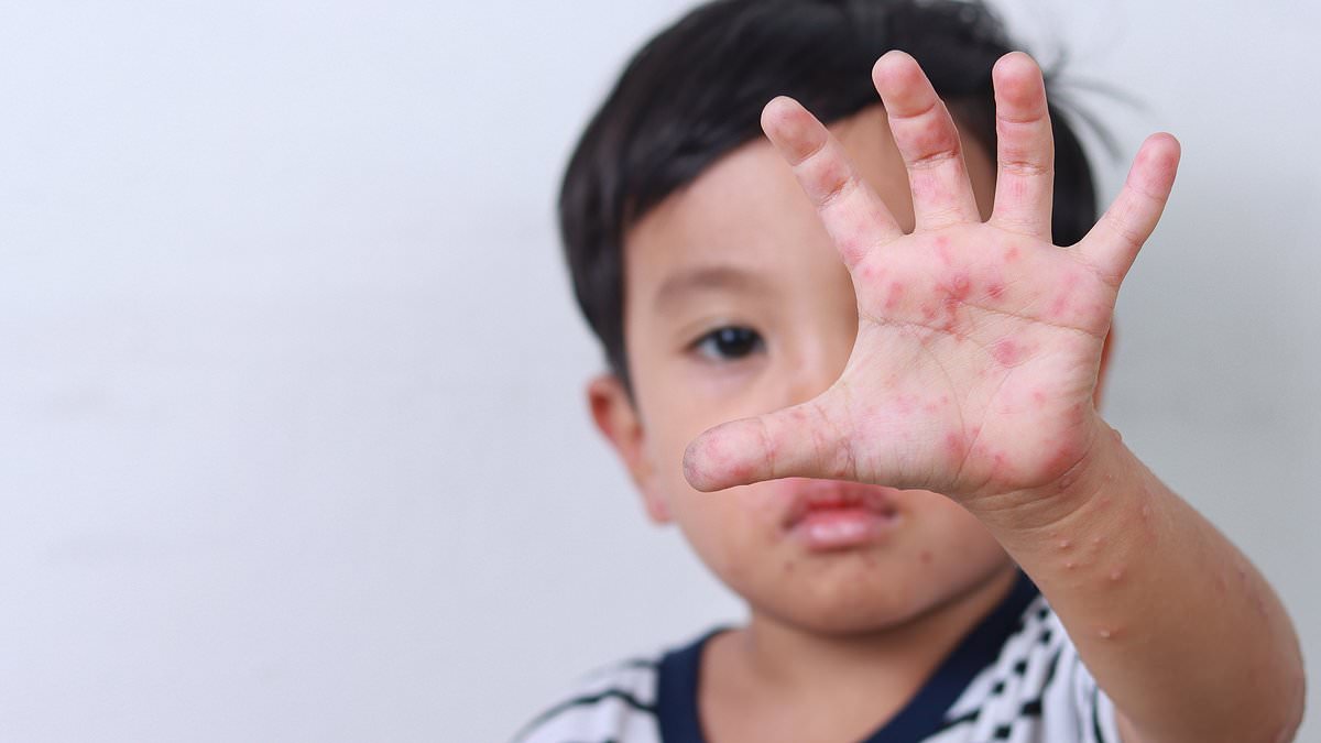 Featured image for "Hand, Foot, and Mouth Disease Outbreak Linked to Water Parks and Playgrounds"