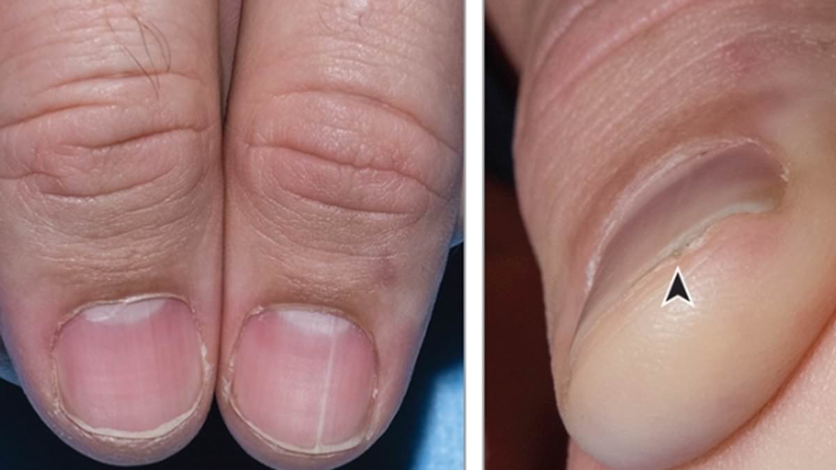 Featured image for "White Line on Nails: Hidden Kidney Cancer Risk"