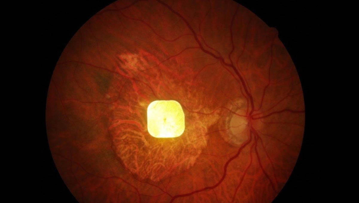 Featured image for Innovative Eye Implants Enable Reading for the Legally Blind