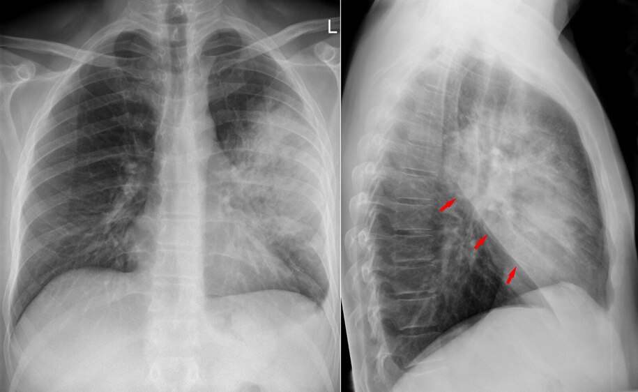 "Pneumonia Vaccines: A Surprising Defense Against Influenza and Covid"
