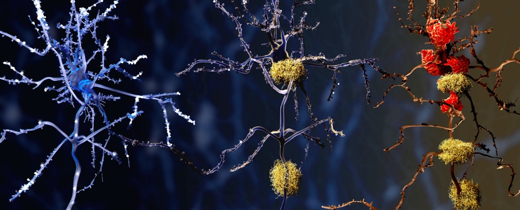 Brain Autopsies Identify Possible Cause of Alzheimer's
