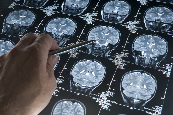 Midlife Indicators Could Predict Alzheimer's Risk Decades Early