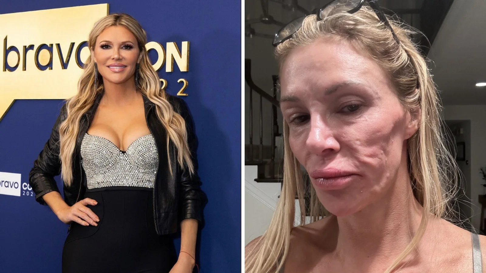Brandi Glanville Faces Financial and Health Challenges After Severe Burns