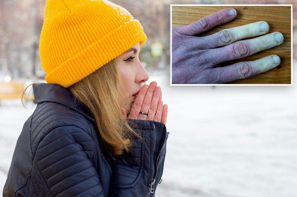 "FDA Approves First Drug for Severe Frostbite"