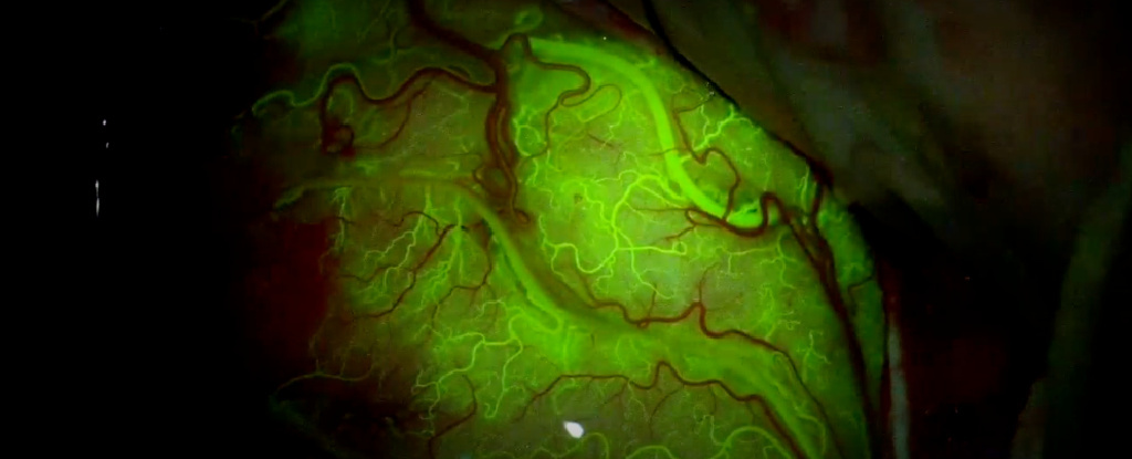Ultrasound breakthrough delivers chemo to brain tumors.