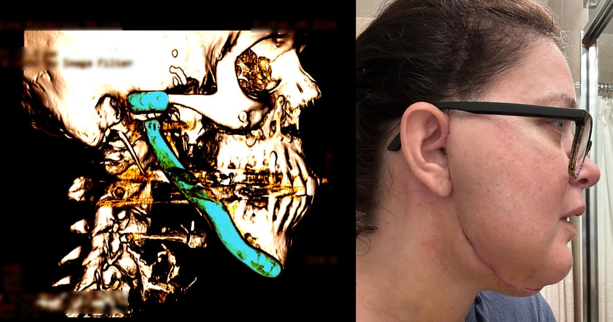 Featured image for "The Perils of TMJ: Understanding Chronic Pain and Treatment Challenges"