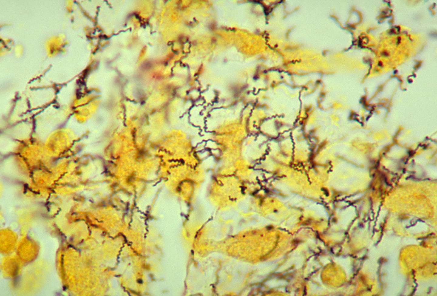 Featured image for "Rising Syphilis Cases: The Growing STI Epidemic in the US"