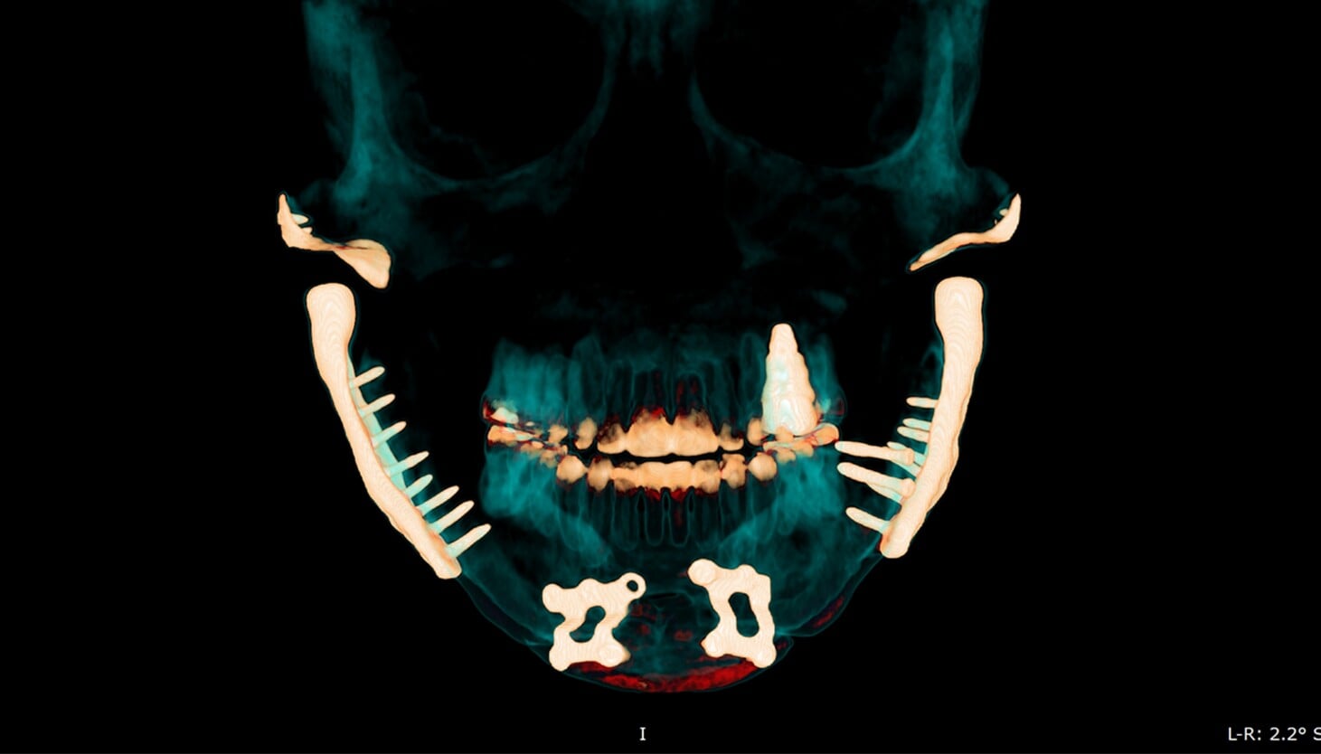 Featured image for "The Perils of TMJ: Chronic Pain, Metal Jaws, and Ineffective Treatments"