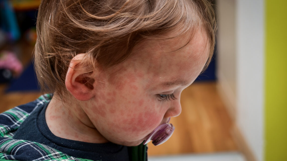 Child in Los Angeles Dies from Rare Measles Complication Years After Infection