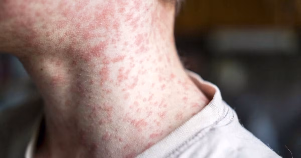 Featured image for Measles Outbreak in Ohio and West Virginia Raises Alarm