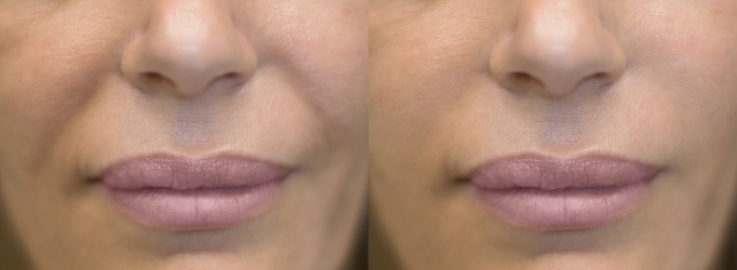"Exploring Treatments for Nasolabial Fold Reduction"