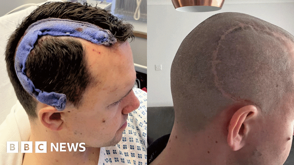 Featured image for West Hanney Man's Brain Tumour Developed Over a Decade