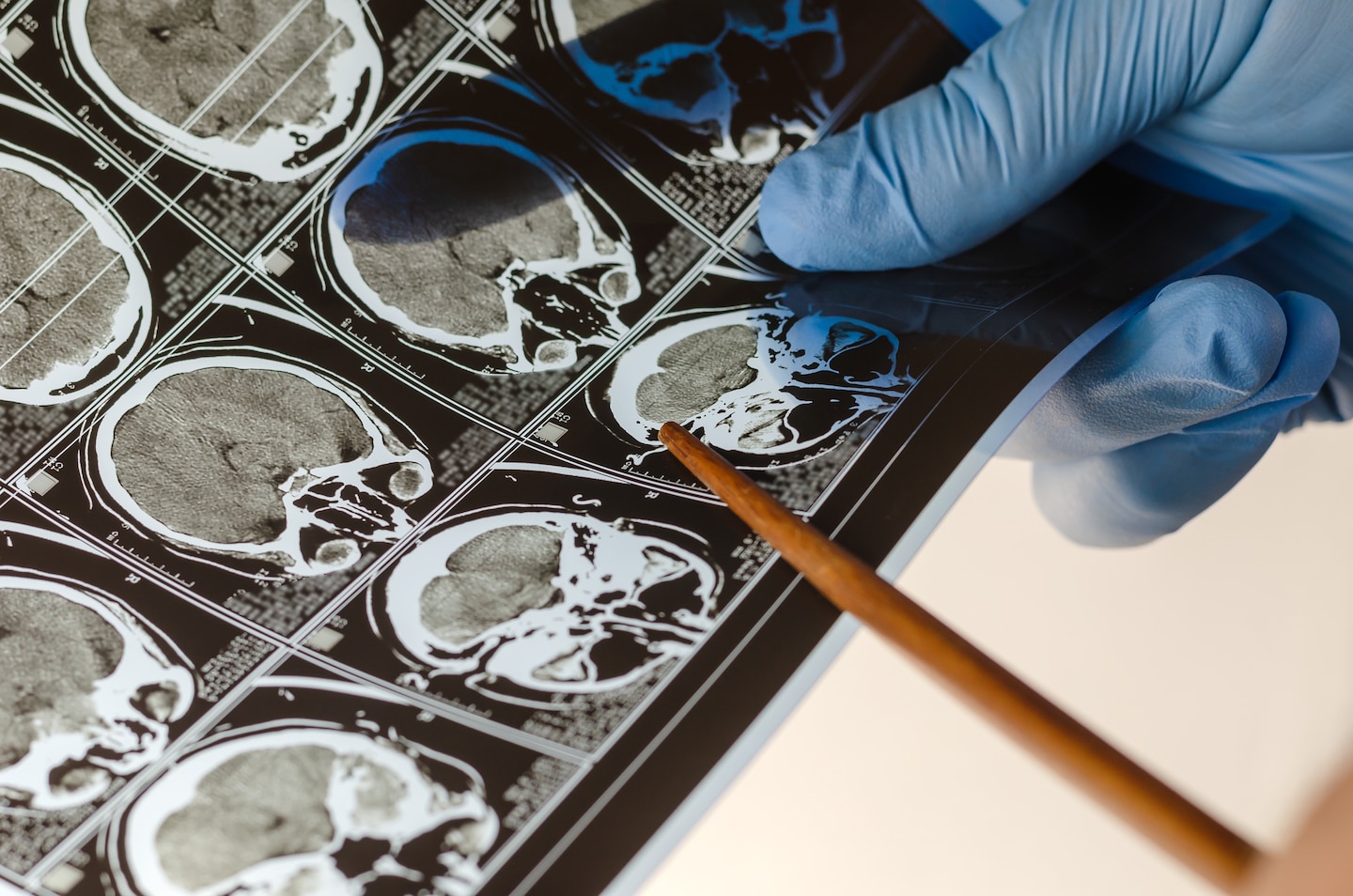 "Unveiling the Gender-Specific Symptoms and Lifestyle Changes to Prevent Stroke"