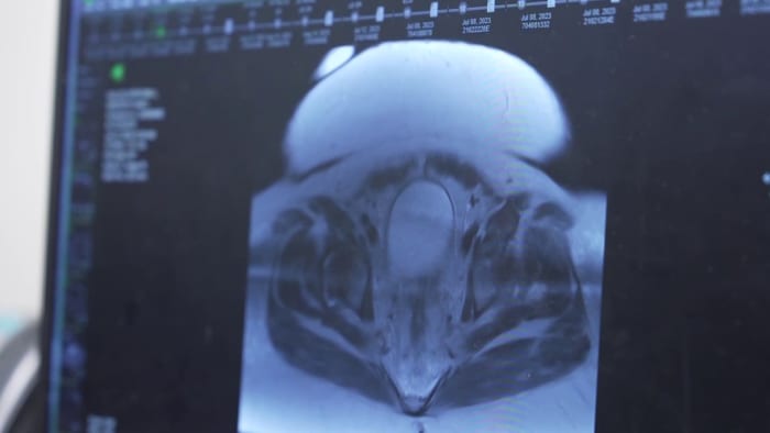 Featured image for "Empowering Colon Cancer Prevention: Lifestyle Choices, Screenings, and Warning Signs"