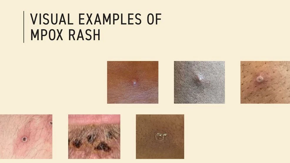 Featured image for Monkeypox Virus Detected in Pierce County Wastewater