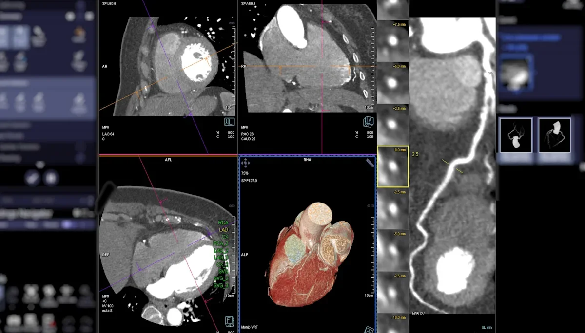 Invisible Pollutants, Visible Heart Risk: Low-Level Air Pollution Linked to Worse Coronary Disease