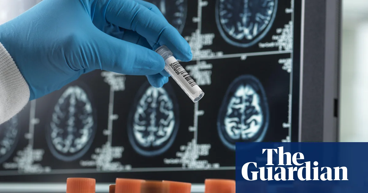 New Blood Test Shows Promise for Early Alzheimer's Detection